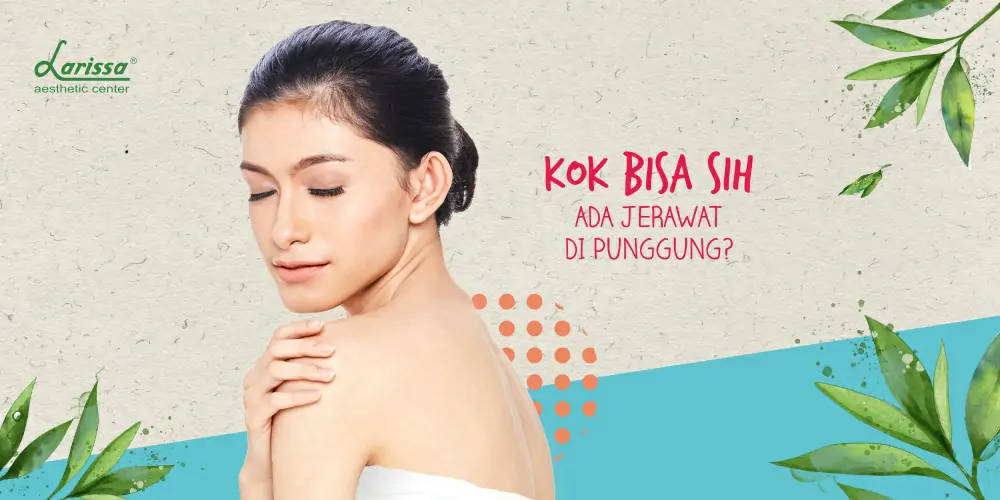 Jerawat Di Punggung Mengganggu? Ini Sebabnya