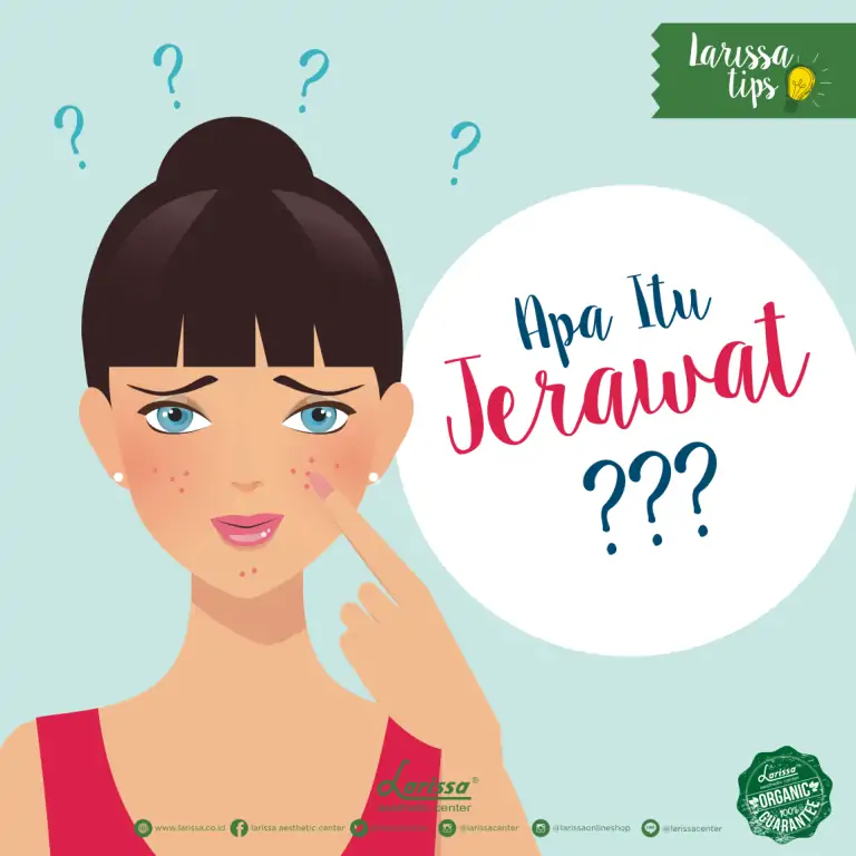 Apa Itu Jerawat dan Faktor Penyebab Jerawat ??