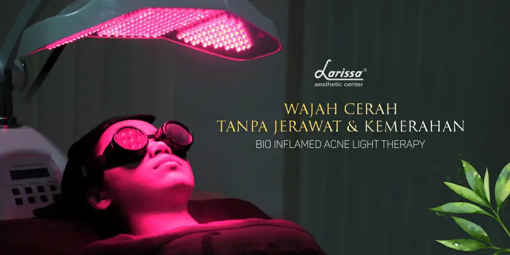 Malu Karena Wajah Memerah Dan Berjerawat, Yuk Coba Perawatan Ini