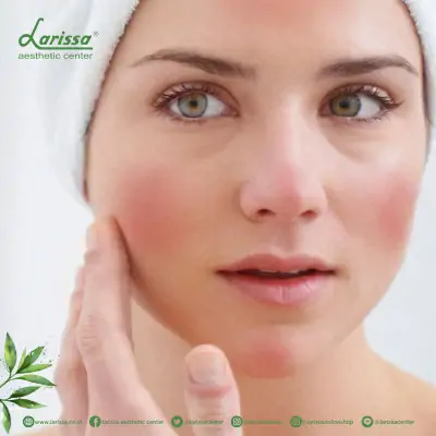 Rosacea, Bukan Jerawat Tapi...