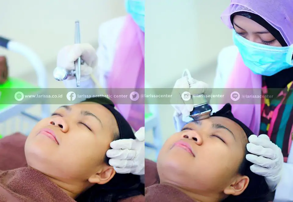 Atasi Problem Kulit Wajah Dengan Larissa Ozone Jet Peel Hitech Larissa