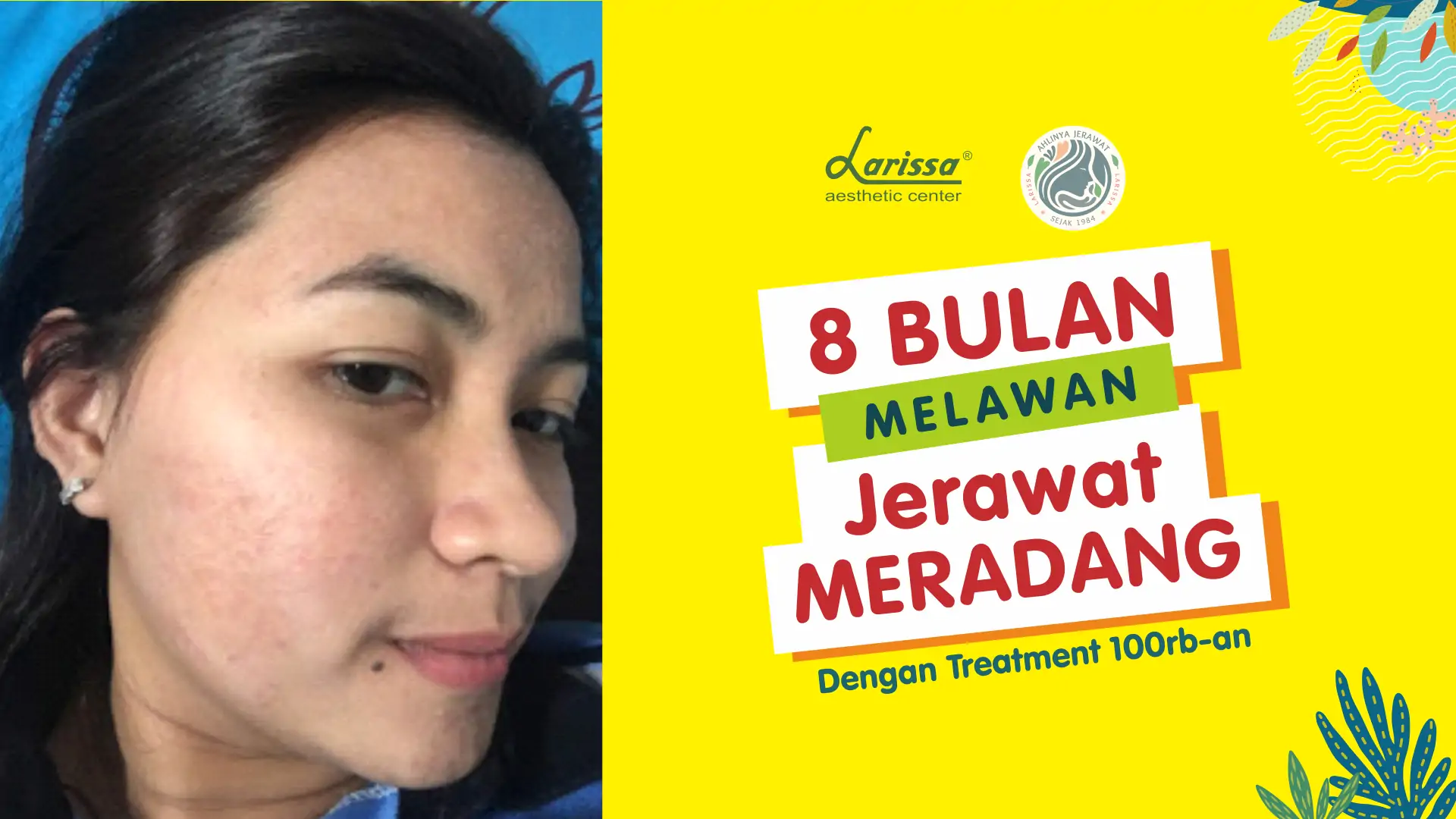 Jerawat Hilang Hanya Dengan Facial Dan Produk Ini!