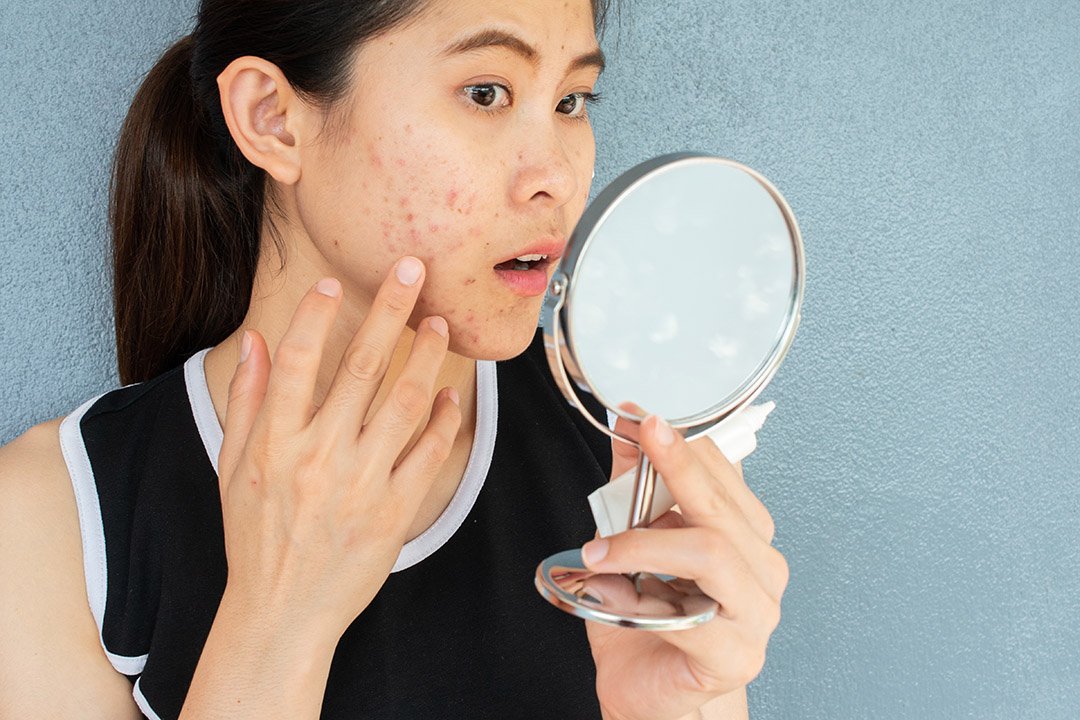 Nggak Pede Selfie di Instagram Tanpa Filter? Yuk Atasi Masalah Bopeng Di Wajah Sejak Dini !